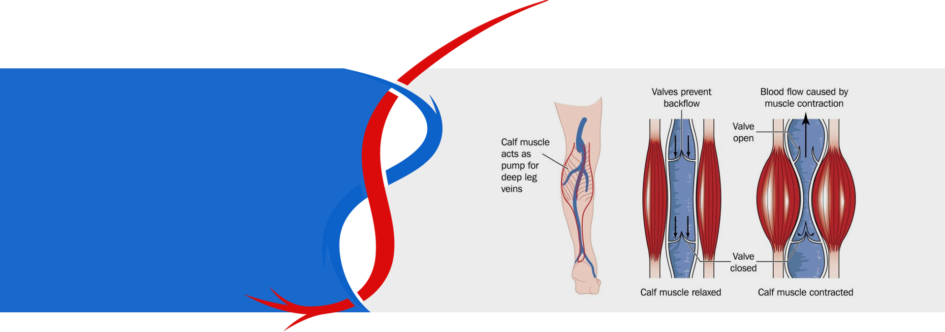 Varicose Veins